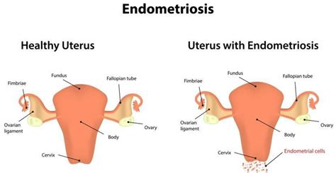 thought it was endometriosis but was cancer